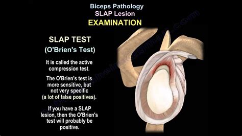 slap lesion tear test|shoulder impingement vs slap tear.